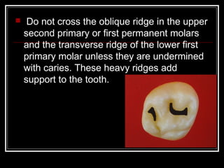  Do not cross the oblique ridge in the upper 
second primary or first permanent molars 
and the transverse ridge of the lower first 
primary molar unless they are undermined 
with caries. These heavy ridges add 
support to the tooth. 
 