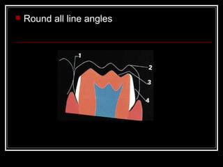  Round all line angles 
 