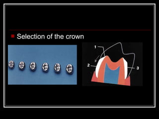  Selection of the crown 
 