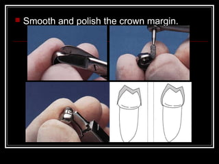  Smooth and polish the crown margin. 
 