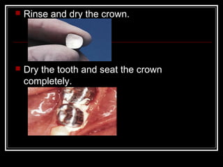  Rinse and dry the crown. 
 Dry the tooth and seat the crown 
completely. 
 