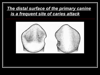 The distal surface of the primary canine 
is a frequent site of caries attack 
 