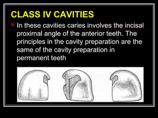 CLASS IV CAVITIES 
 In these cavities caries involves the incisal 
proximal angle of the anterior teeth. The 
principles in the cavity preparation are the 
same of the cavity preparation in 
permanent teeth 
 
