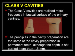 CLASS V CAVITIES 
 The Class V cavities are realized more 
frequently in buccal surface of the primary 
canines. 
 The principles in the cavity preparation are 
the same of the cavity preparation in 
permanent teeth, although the depth is not 
carried more than 1.5 mm. 
 