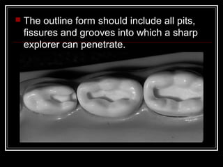    The outline form should include all pits,
    fissures and grooves into which a sharp
    explorer can penetrate.
 