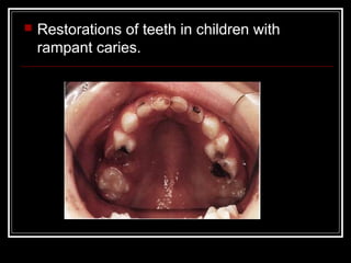    Restorations of teeth in children with
    rampant caries.
 