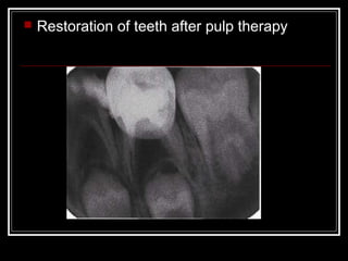    Restoration of teeth after pulp therapy
 