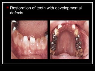    Restoration of teeth with developmental
    defects
 