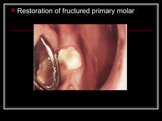    Restoration of fructured primary molar
 
