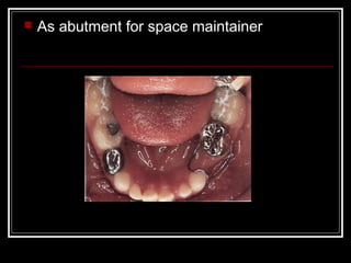    As abutment for space maintainer
 