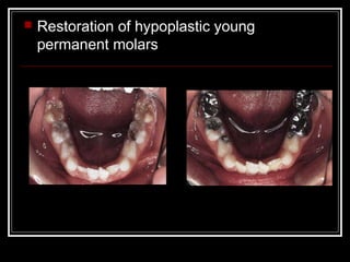    Restoration of hypoplastic young
    permanent molars
 