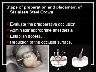 Steps of preparation and placement of
  Stainless Steel Crown.

   Evaluate the preoperative occlusion.
   Administer appropriate anesthesia.
   Establish access.
   Reduction of the occlusal surface.
 