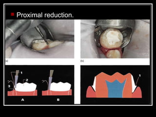    Proximal reduction.
 