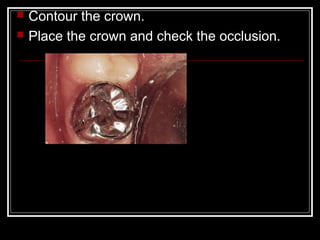  Contour the crown.
 Place the crown and check the occlusion.
 