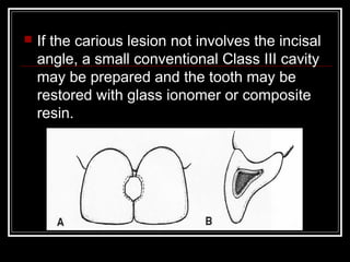    If the carious lesion not involves the incisal
    angle, a small conventional Class III cavity
    may be prepared and the tooth may be
    restored with glass ionomer or composite
    resin.
 