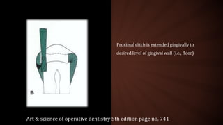 Proximal ditch is extended gingivally to
desired level of gingival wall (i.e., floor)
Art & science of operative dentistry 5th edition page no. 741
 