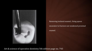 Removing isolated enamel., Using spoon
excavator to fracture out weakened proximal
enamel.
Art & science of operative dentistry 5th edition page no. 743
 