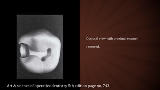 Occlusal view with proximal enamel
removed.
Art & science of operative dentistry 5th edition page no. 743
 