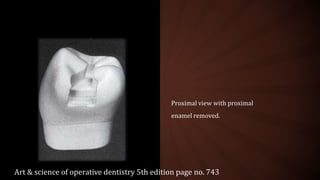 Proximal view with proximal
enamel removed.
Art & science of operative dentistry 5th edition page no. 743
 