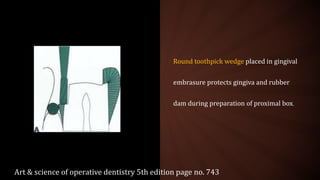 Round toothpick wedge placed in gingival
embrasure protects gingiva and rubber
dam during preparation of proximal box.
Art & science of operative dentistry 5th edition page no. 743
 