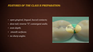 FEATURES OF THE CLASS II PREPARATION:
• open gingival, lingual, buccal contacts;
• dove tail; reverse “S”; convergent walls;
• even depth;
• smooth surfaces;
• no sharp angles.
 