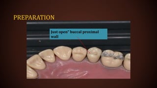 PREPARATION
Just open” buccal proximal
wall
 