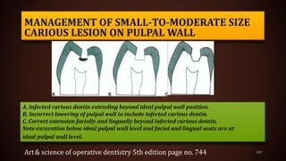 MANAGEMENT OF SMALL-TO-MODERATE SIZE
CARIOUS LESION ON PULPAL WALL
119
A, Infected carious dentin extending beyond ideal pulpal wall position.
B, Incorrect lowering of pulpal wall to include infected carious dentin.
C, Correct extension facially and lingually beyond infected carious dentin.
Note excavation below ideal pulpal wall level and facial and lingual seats are at
ideal pulpal wall level.
Art& science of operative dentistry 5th edition page no. 744
 