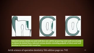 120
Infected carious dentin on axial wall does not call for preparing axial wall toward pulp
as shown by dotted lines. Infected carious dentin extending pulpally of ideal axial wall
position is removed with round bur.
Art& science of operative dentistry 5th edition page no. 745
 
