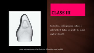 CLASS III
Restorations on the proximal surfaces of
anterior teeth that do not involve the incisal
angle are Class III
Art & science of operative dentistry 5th edition page no.296
 