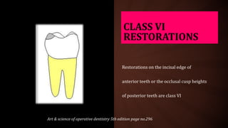 CLASS VI
RESTORATIONS
Restorations on the incisal edge of
anterior teeth or the occlusal cusp heights
of posterior teeth are class VI
Art & science of operative dentistry 5th edition page no.296
 