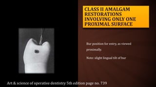 CLASS II AMALGAM
RESTORATIONS
INVOLVING ONLY ONE
PROXIMAL SURFACE
Bur position for entry, as viewed
proximally.
Note: slight lingual tilt of bur
Art & science of operative dentistry 5th edition page no. 739
 