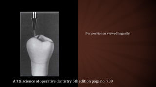Bur position as viewed lingually.
Art & science of operative dentistry 5th edition page no. 739
 