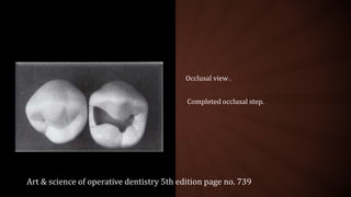 Occlusal view .
Completed occlusal step.
Art & science of operative dentistry 5th edition page no. 739
 