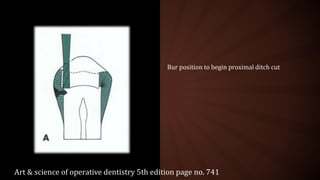 Bur position to begin proximal ditch cut
Art & science of operative dentistry 5th edition page no. 741
 