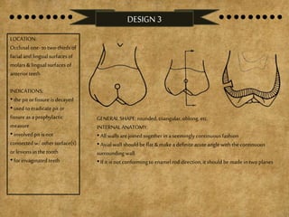 DESIGN 3
LOCATION:
Occlusal one-to two-thirds of
facial and lingual surfaces of
molars & lingual surfaces of
anterior teeth
INDICATIONS:
•the pit orfissure is decayed
•used to eradicate pit or
fissure as a prophylactic
measure
•involved pit is not
connected w/ other surface(s)
or lesions inthe tooth
•for invaginated teeth
GENERALSHAPE: rounded, triangular,oblong, etc.
INTERNALANATOMY:
•All walls are joined together in a seemingly continuous fashion
•Axial wall should be flat &makea definite acuteangle with the continuous
surroundingwall
•If it is not conformingto enamelrod direction, it should bemade intwo planes
 