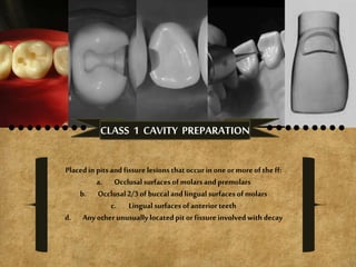 CLASS 1 CAVITY PREPARATION
Placedinpits andfissure lesions thatoccurinoneor moreof theff:
a. Occlusalsurfacesof molarsandpremolars
b. Occlusal2/3of buccalandlingualsurfaces ofmolars
c. Lingualsurfacesof anterior teeth
d. Anyother unusuallylocatedpit or fissure involved with decay
 