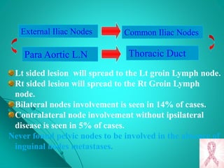 Lt sided lesion will spread to the Lt groin Lymph node.
Rt sided lesion will spread to the Rt Groin Lymph
node.
Bilateral nodes involvement is seen in 14% of cases.
Contralateral node involvement without ipsilateral
disease is seen in 5% of cases.
Never found pelvic nodes to be involved in the absence of
inguinal nodes metastases.
External Iliac Nodes Common Iliac Nodes
Para Aortic L.N Thoracic Duct
 