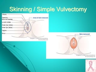 Skinning / Simple Vulvectomy
 