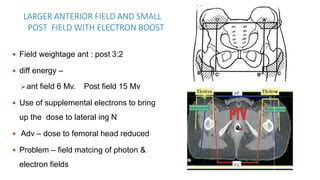 LARGER ANTERIOR FIELD AND SMALL
POST FIELD WITH ELECTRON BOOST
 Field weightage ant : post 3:2
 diff energy –
ant field 6 Mv. Post field 15 Mv
 Use of supplemental electrons to bring
up the dose to lateral ing N
 Adv – dose to femoral head reduced
 Problem – field matcing of photon &
electron fields
 