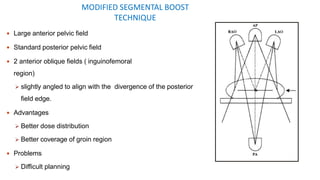 MODIFIED SEGMENTAL BOOST
TECHNIQUE
 Large anterior pelvic field
 Standard posterior pelvic field
 2 anterior oblique fields ( inguinofemoral
region)
 slightly angled to align with the divergence of the posterior
field edge.
 Advantages
 Better dose distribution
 Better coverage of groin region
 Problems
 Difficult planning
 