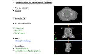 1. Patient position for simulation and treatment:
• Frog leg position
• Vac-lok
2. Planning CT:
• 3-5 mm slice thickness
 Oral contrast
 IV contrast
 Rectal contrast
• VOI….
Atleast L2 to mid thigh
• Isocenter…
• Centre of pelvis, or…
• Vulva at the level of pubic symphysis
 