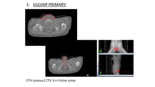 1. VULVAR PRIMARY:
CTV tumour/ CTV 1>> Entire vulva
 