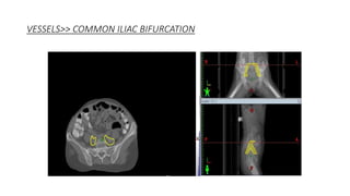VESSELS>> COMMON ILIAC BIFURCATION
 