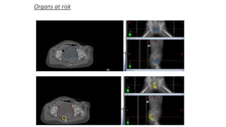 Organs at risk
 