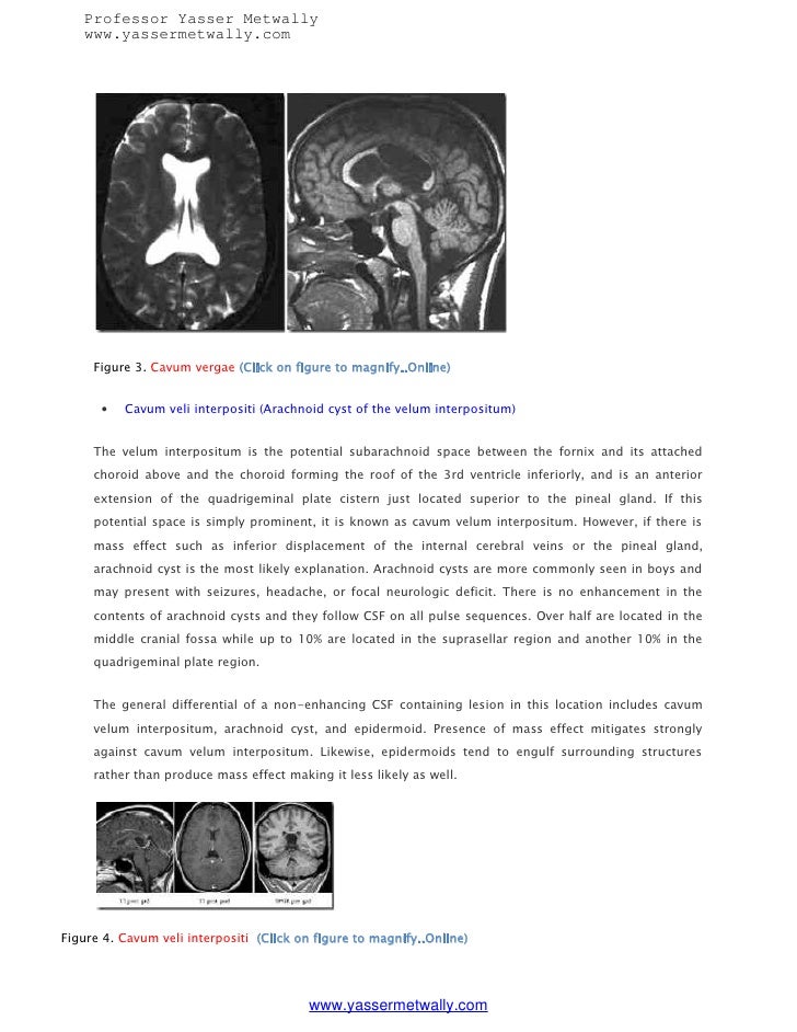 Cavum septum pellucidum (CSP), Cavum vergae and Cavum veli interpositi