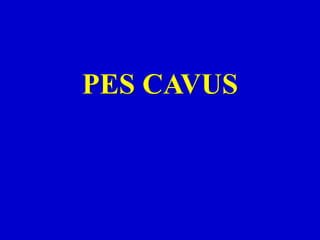 PES CAVUS
 