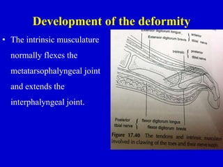 Development of the deformity
• The intrinsic musculature
normally flexes the
metatarsophalyngeal joint
and extends the
interphalyngeal joint.
 