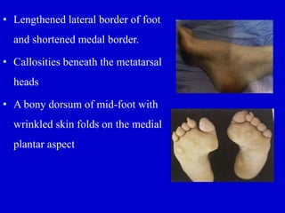 • Lengthened lateral border of foot
and shortened medal border.
• Callosities beneath the metatarsal
heads
• A bony dorsum of mid-foot with
wrinkled skin folds on the medial
plantar aspect
 
