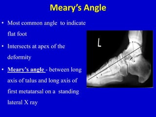 Meary’s Angle
• Most common angle to indicate
flat foot
• Intersects at apex of the
deformity
• Meary’s angle - between long
axis of talus and long axis of
first metatarsal on a standing
lateral X ray
 