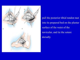•
pull the posterior tibial tendon taut
into its prepared bed on the plantar
surface of the waist of the
navicular, and tie the suture
dorsally
 